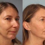 rhinoplasty-merged
