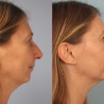 rhinoplasty-merged