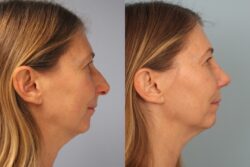 before and after rhinoplasty