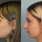 rhinoplasty-merged