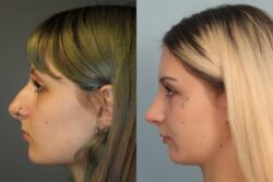 before and after rhinoplasty