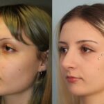 rhinoplasty-merged