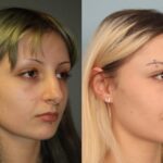 rhinoplasty-merged