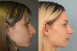 before and after rhinoplasty