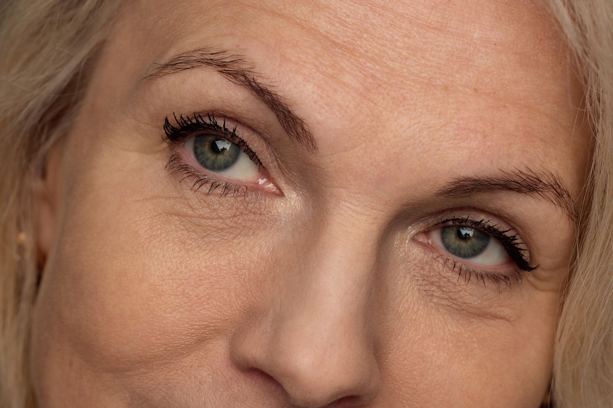 Tired Eyes or Drooping Lids? Choosing Between a Brow Lift and Blepharoplasty