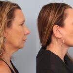 facelift-merged