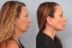before and after facelift