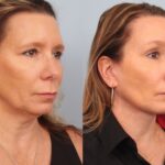 facelift-merged