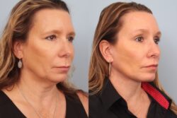 before and after facelift