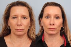 before and after facelift