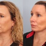 facelift-merged