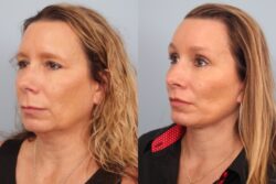 before and after facelift