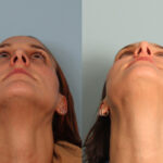 rhinoplasty-merged