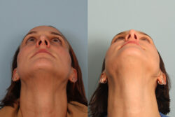 before and after rhinoplasty