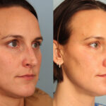 rhinoplasty-merged