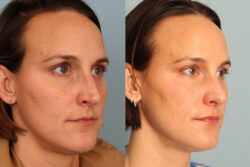 before and after rhinoplasty