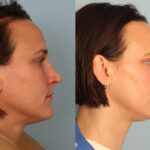 rhinoplasty-merged
