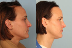 before and after rhinoplasty
