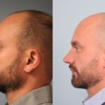 rhinoplasty-merged
