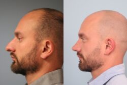 before and after rhinoplasty