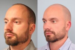 before and after rhinoplasty