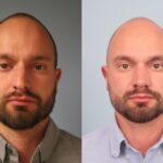 rhinoplasty-merged