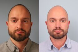 before and after rhinoplasty