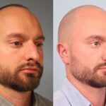 rhinoplasty-merged