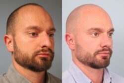 before and after rhinoplasty