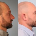 rhinoplasty-merged