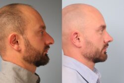 before and after rhinoplasty