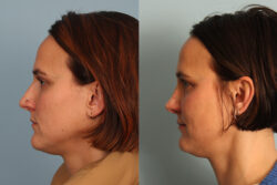 before and after rhinoplasty
