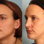 rhinoplasty-merged