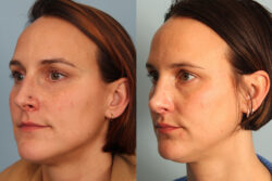 before and after rhinoplasty