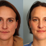 rhinoplasty-merged