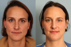 before and after rhinoplasty