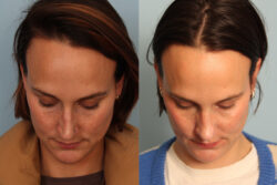 before and after rhinoplasty
