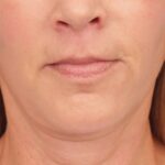 lip-lift-after