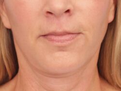 after lip lift