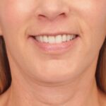lip-lift-after