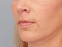after lip lift