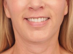 after lip lift