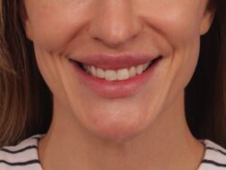 after lip lift