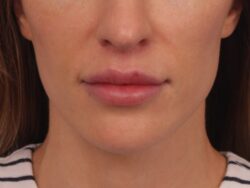 after lip lift
