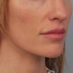 lip-lift-after