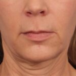 lip-lift-before
