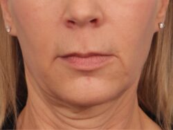 before lip lift