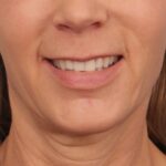 lip-lift-before