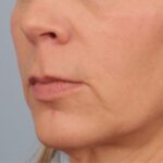 lip-lift-before