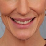 lip-lift-before